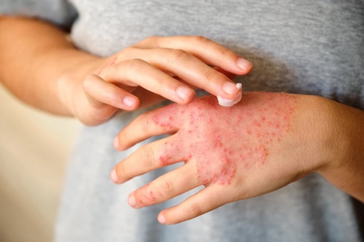 Soothing the skin can help reduce eczema flare-ups. Ladanifer/iStock via Getty