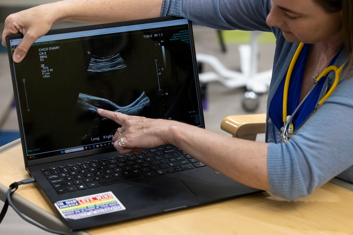 GettyImages-2241106538_resized Polycystic ovary syndrome researcher Melanie Cree points to an image of ovaries from an ultrasoun...