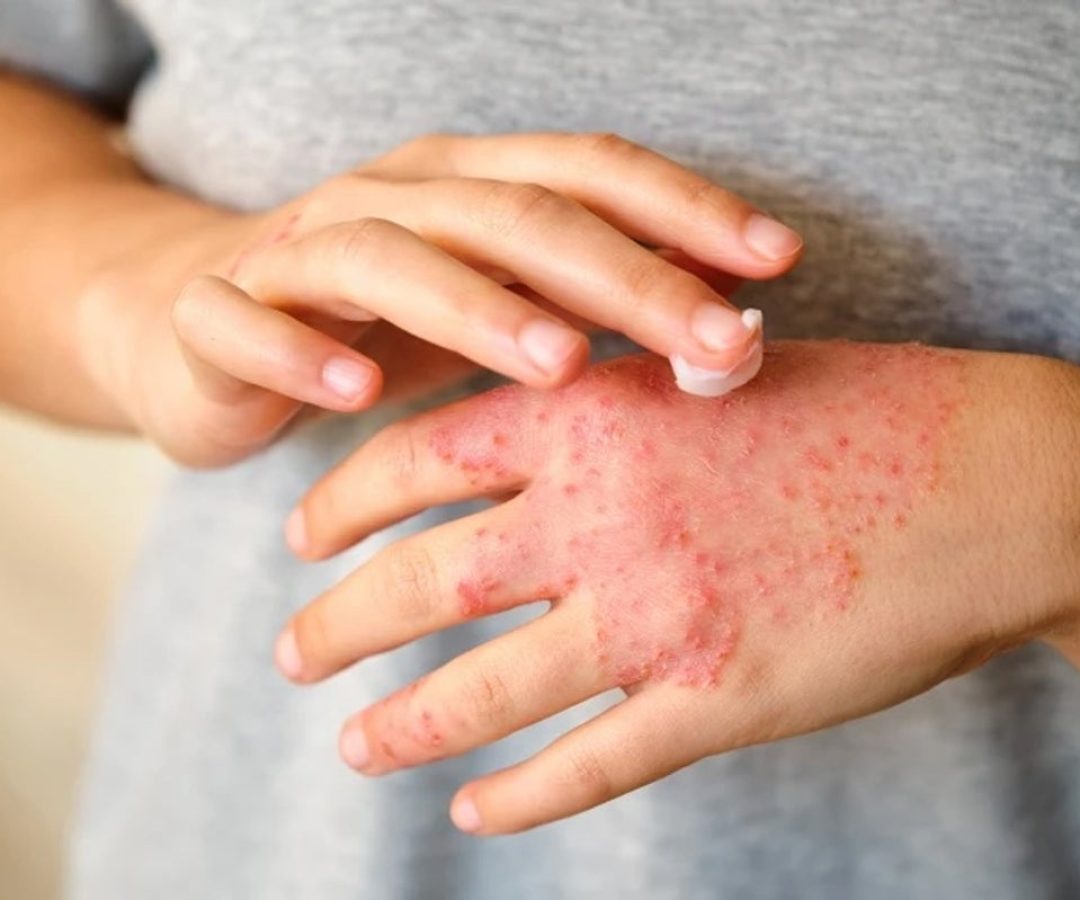 Soothing the skin can help reduce eczema flare-ups. Ladanifer/iStock via Getty