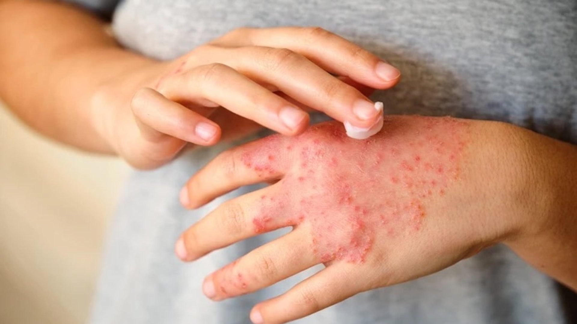 Soothing the skin can help reduce eczema flare-ups. Ladanifer/iStock via Getty